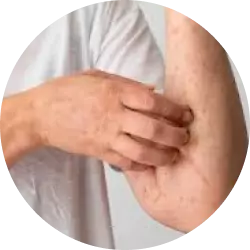pengobatan sifilis