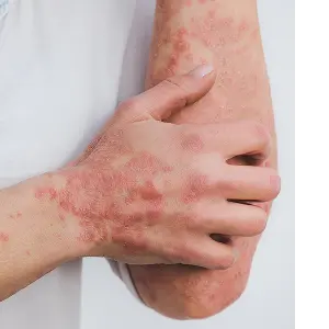 kulit terasa panas