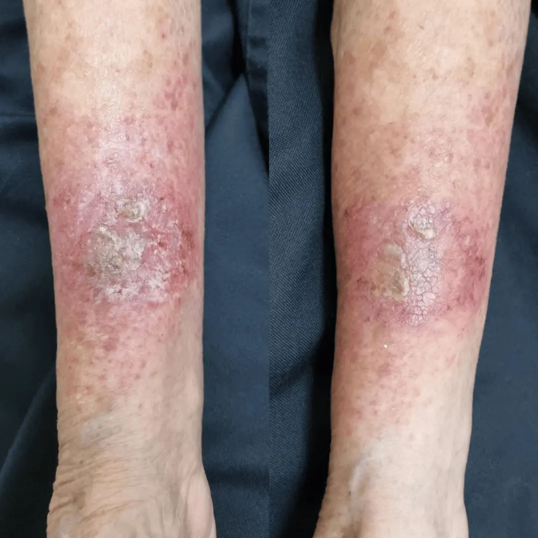 apa itu terapi dermatitis atopik di bawah spandi atas dupilumab di bawah orspandi atas 10014140909