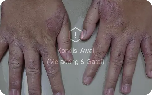 terapi dupilumab