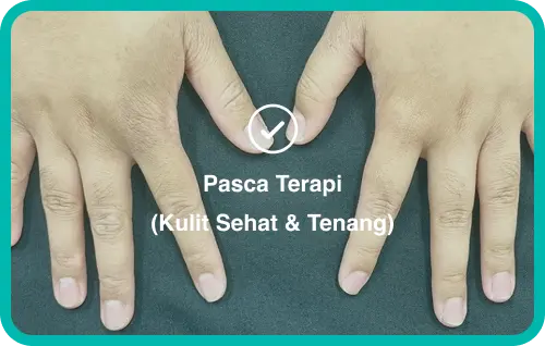 pengobatan dermatitis