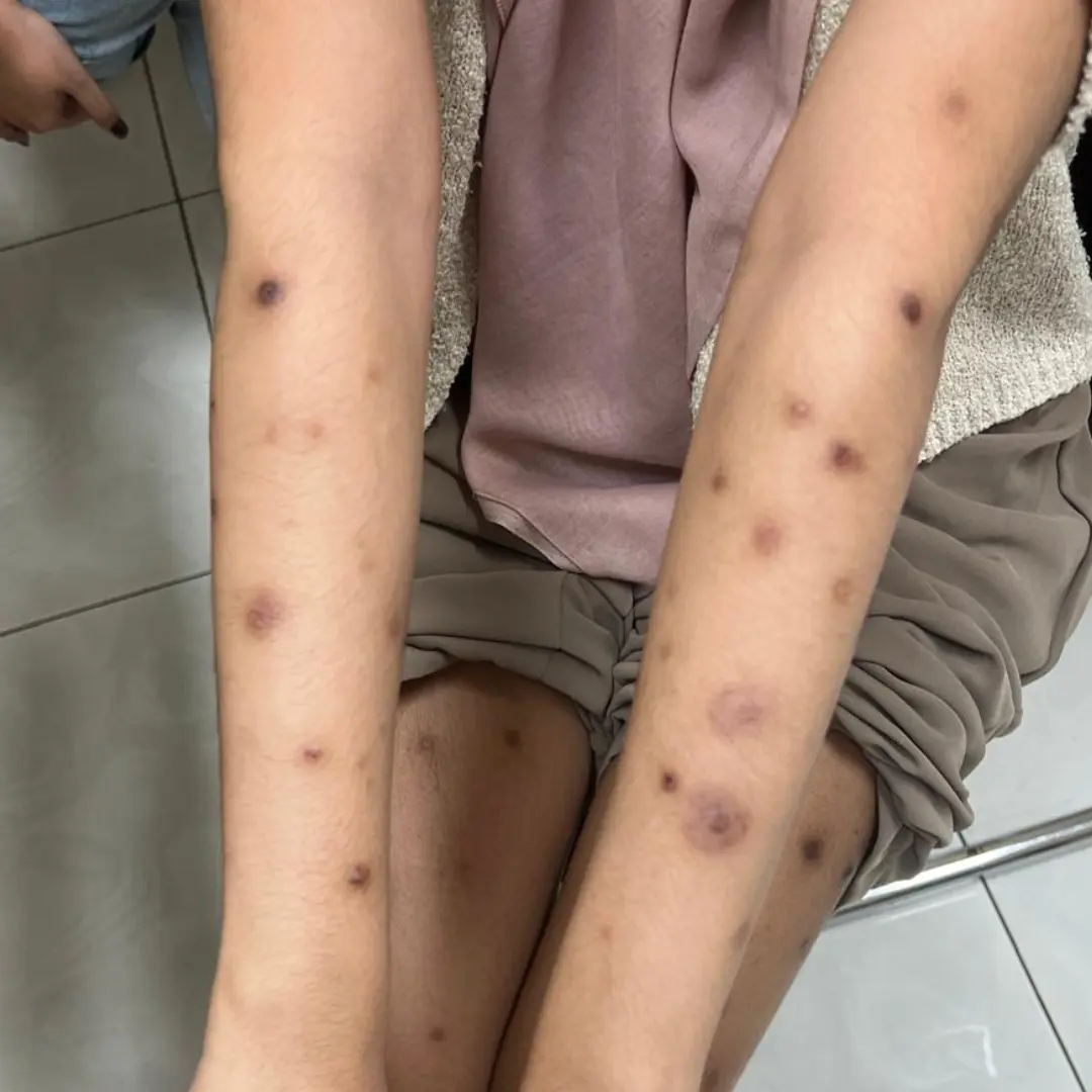 perubahan warna kulit hiperpigmentasiordi bawah br ordi atas hipopigmentasi setelah sembuh 10010010074