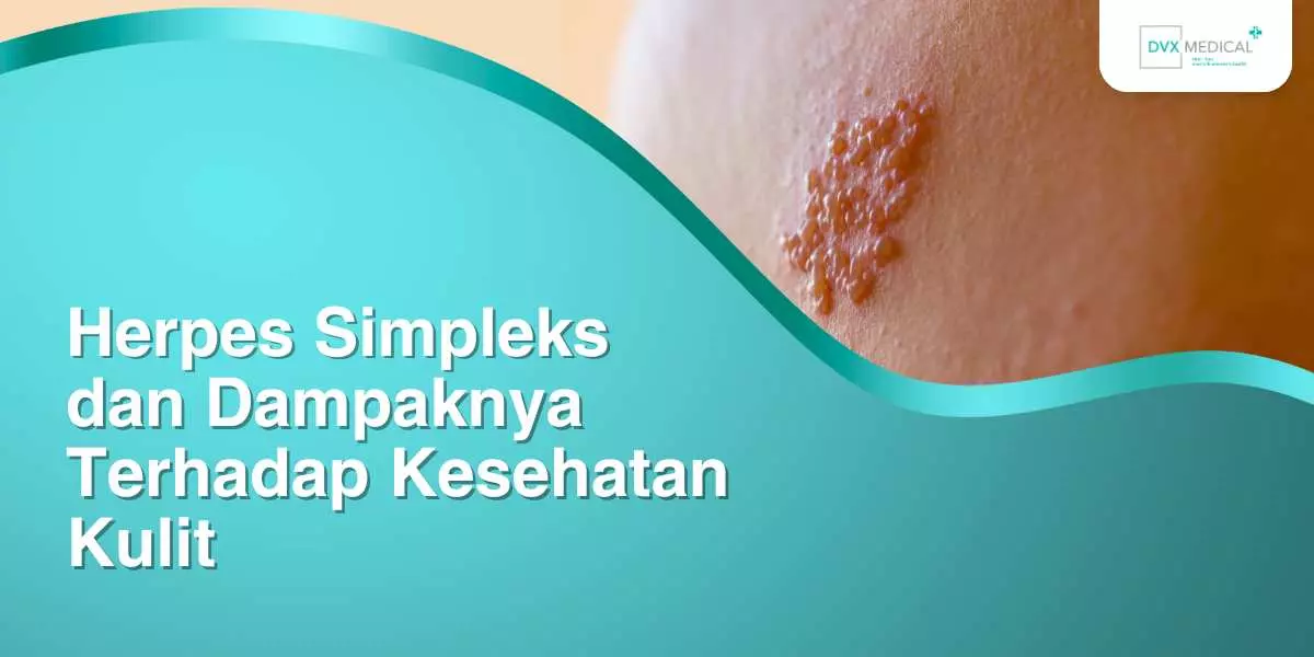 Herpes Simpleks dan Dampaknya Terhadap Kesehatan Kulit