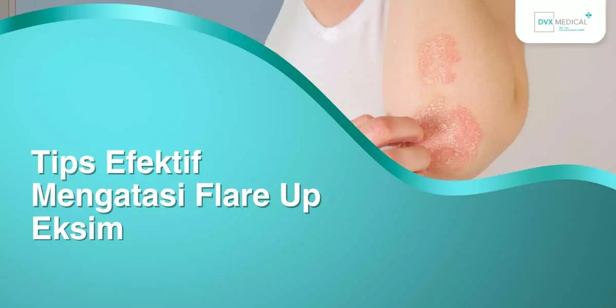 Tips Efektif Mengatasi Flare Up Eksim