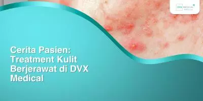 Cerita Pasien: Treatment Kulit Berjerawat di DVX Medical