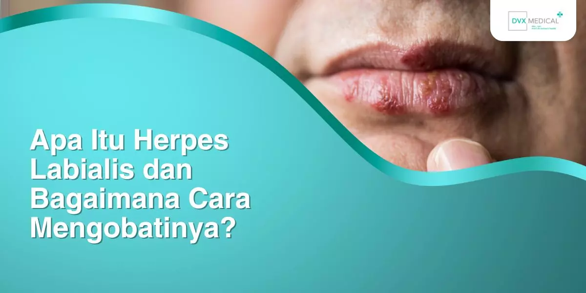Apa Itu Herpes Labialis dan Bagaimana Cara Mengobatinya?
