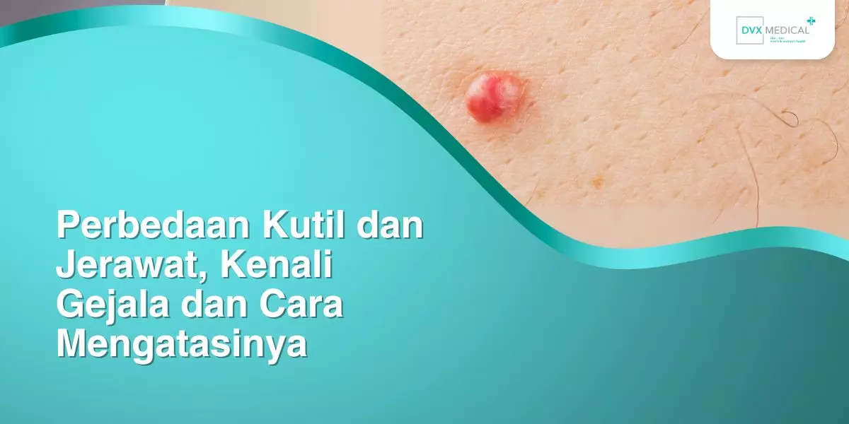 Perbedaan Kutil dan Jerawat, Kenali Gejala dan Cara Mengatasinya