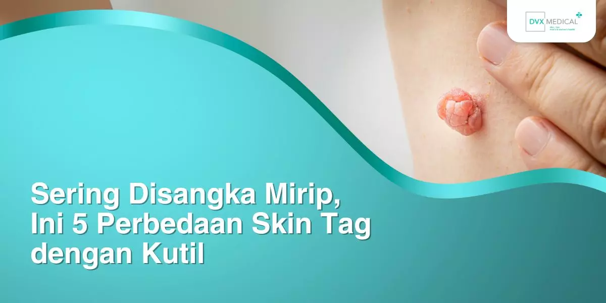 Sering Disangka Mirip, Ini 5 Perbedaan Skin Tag dengan Kutil