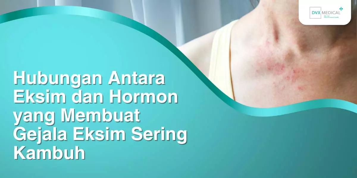 Hubungan Antara Eksim dan Hormon yang Membuat Gejala Eksim Sering Kambuh