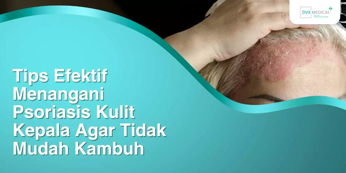 Tips Efektif Menangani Psoriasis Kulit Kepala Agar Tidak Mudah Kambuh