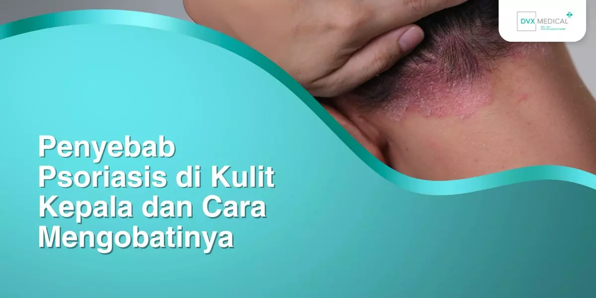 Penyebab Psoriasis di Kulit Kepala dan Cara Mengobatinya