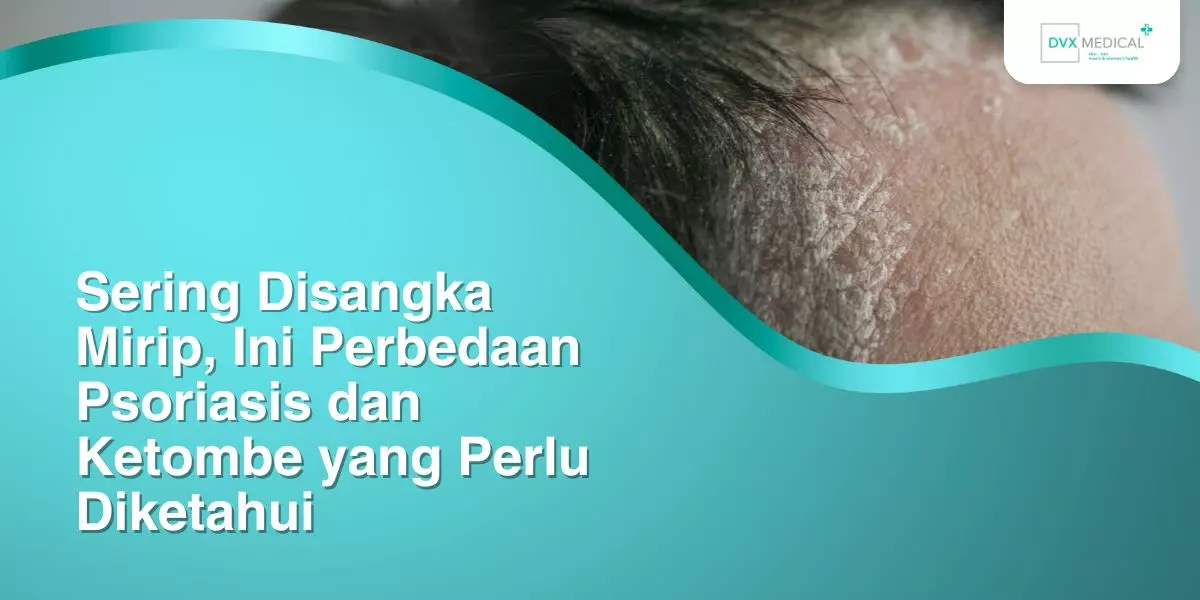 Sering Disangka Mirip, Ini Perbedaan Psoriasis dan Ketombe yang Perlu Diketahui
