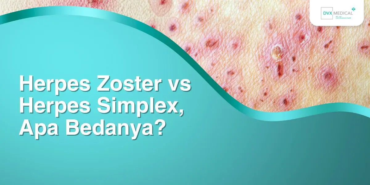 Herpes Zoster vs Herpes Simplex, Apa Bedanya?