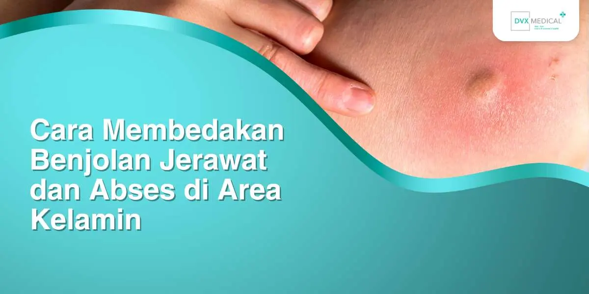 Cara Membedakan Benjolan Jerawat dan Abses di Area Kelamin