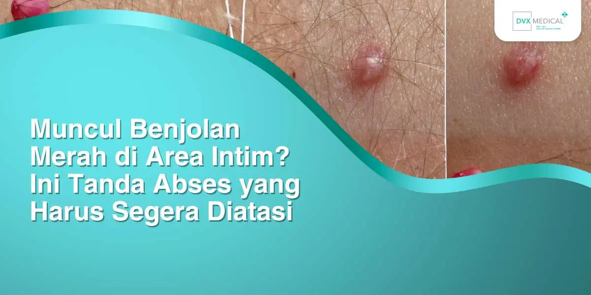 Muncul Benjolan Merah di Area Intim? Ini Tanda Abses yang Harus Segera Diatasi