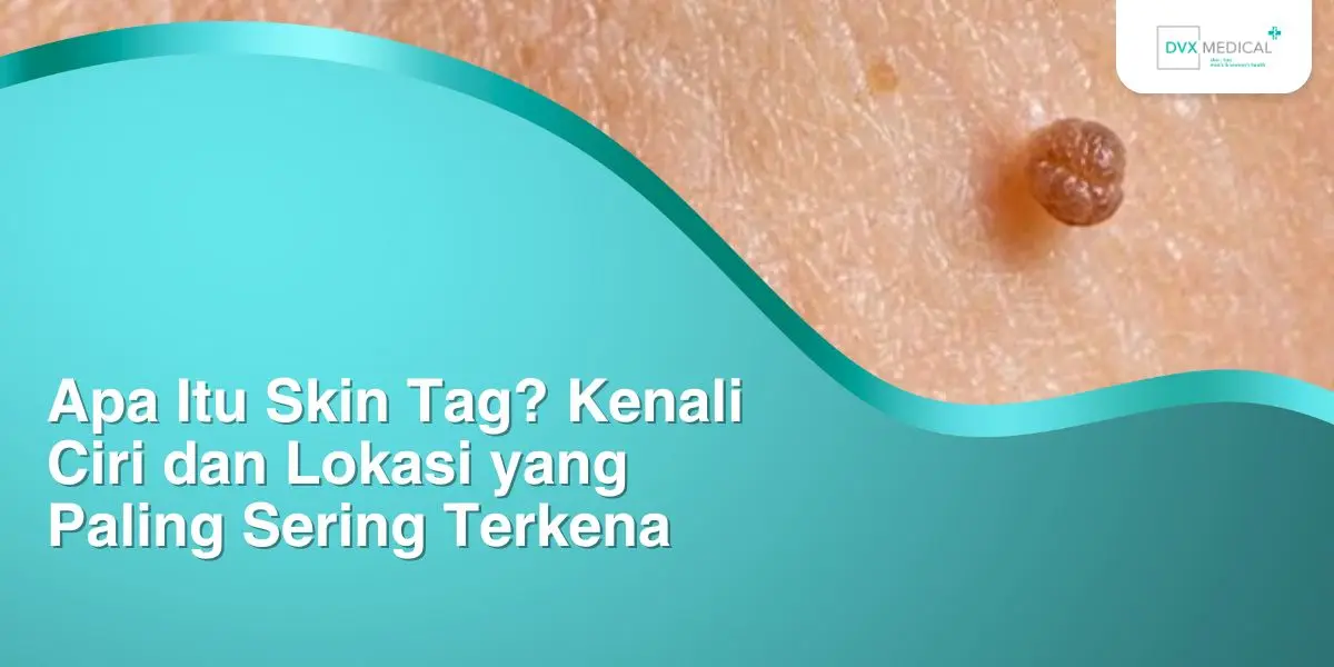 Apa Itu Skin Tag? Kenali Ciri dan Lokasi yang Paling Sering Terkena