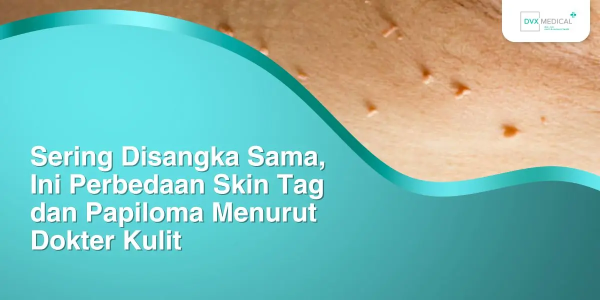 Sering Disangka Sama, Ini Perbedaan Skin Tag dan Papiloma Menurut Dokter Kulit