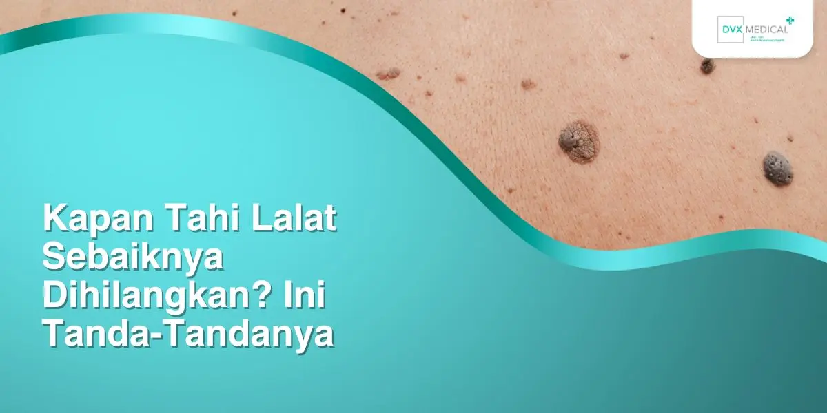 Kapan Tahi Lalat Sebaiknya Dihilangkan? Ini Tanda-Tandanya