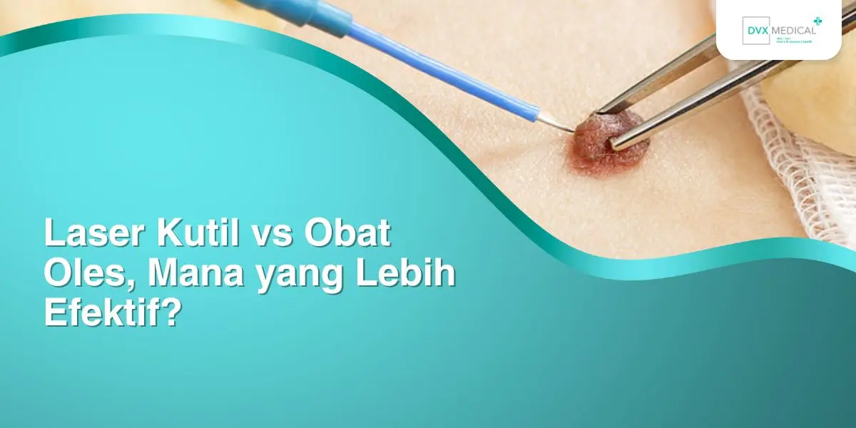Laser Kutil vs Obat Oles, Mana yang Lebih Efektif?