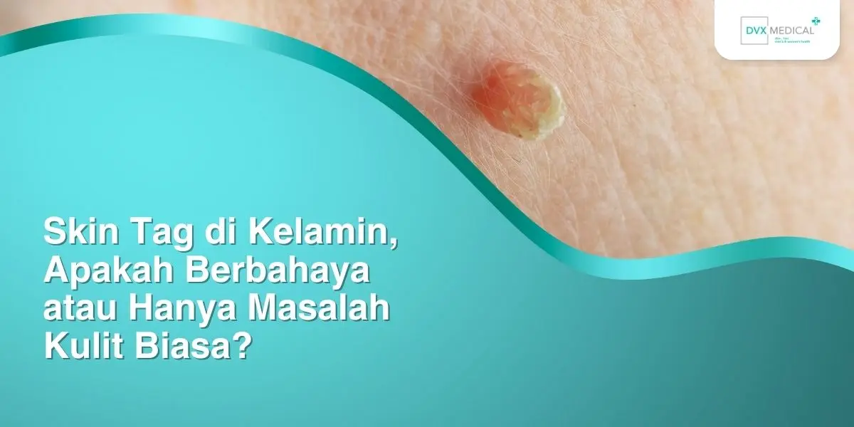 Skin Tag di Kelamin, Apakah Berbahaya atau Hanya Masalah Kulit Biasa?