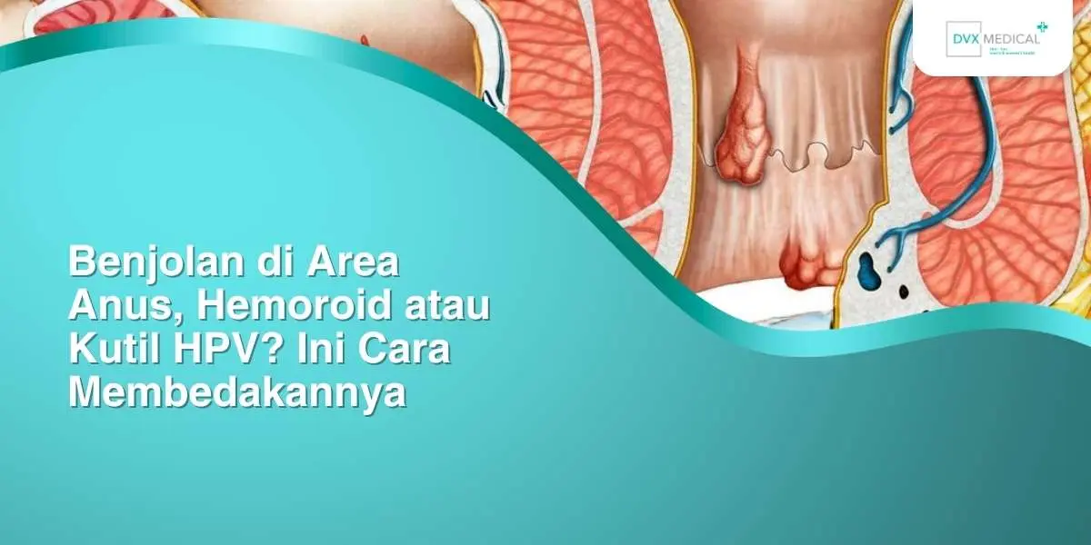 Benjolan di Area Anus, Hemoroid atau Kutil HPV? Ini Cara Membedakannya