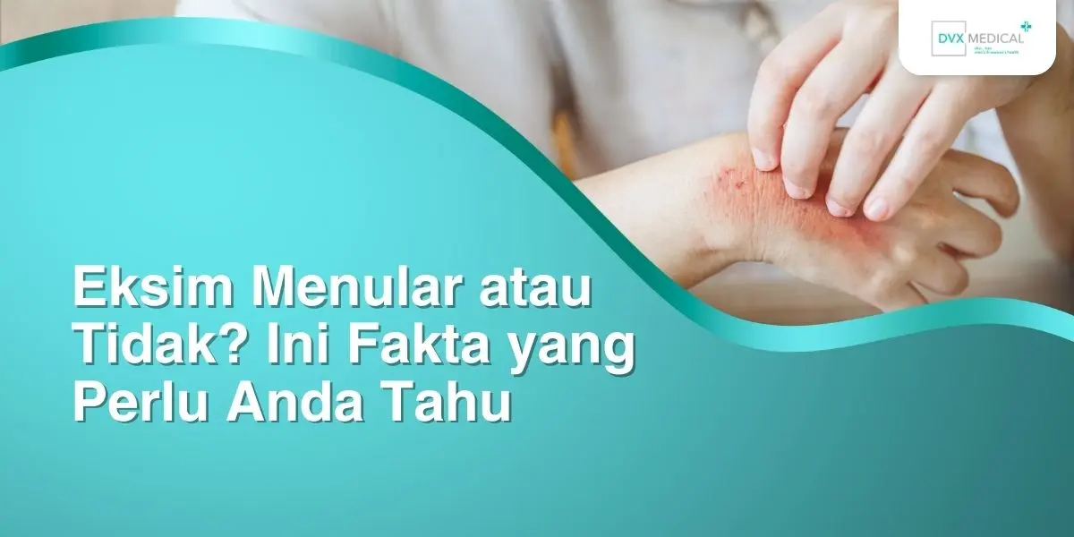 Eksim Menular atau Tidak? Ini Fakta yang Perlu Anda Tahu