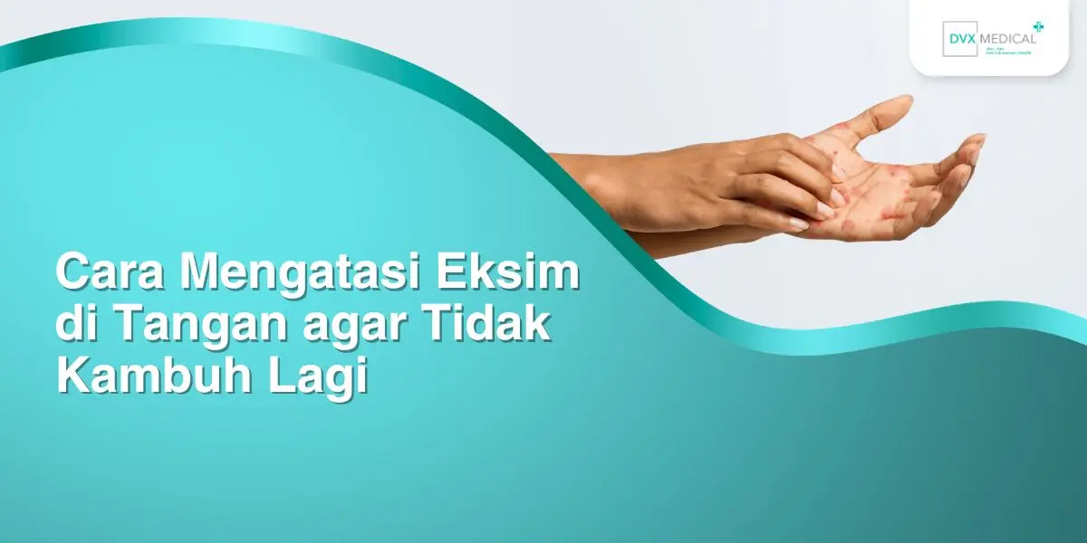 Cara Mengatasi Eksim di Tangan agar Tidak Kambuh Lagi