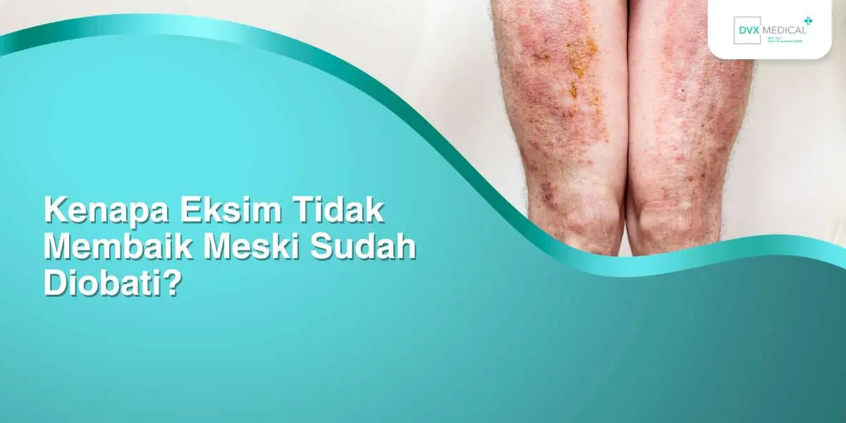 Kenapa Eksim Tidak Membaik Meski Sudah Diobati?
