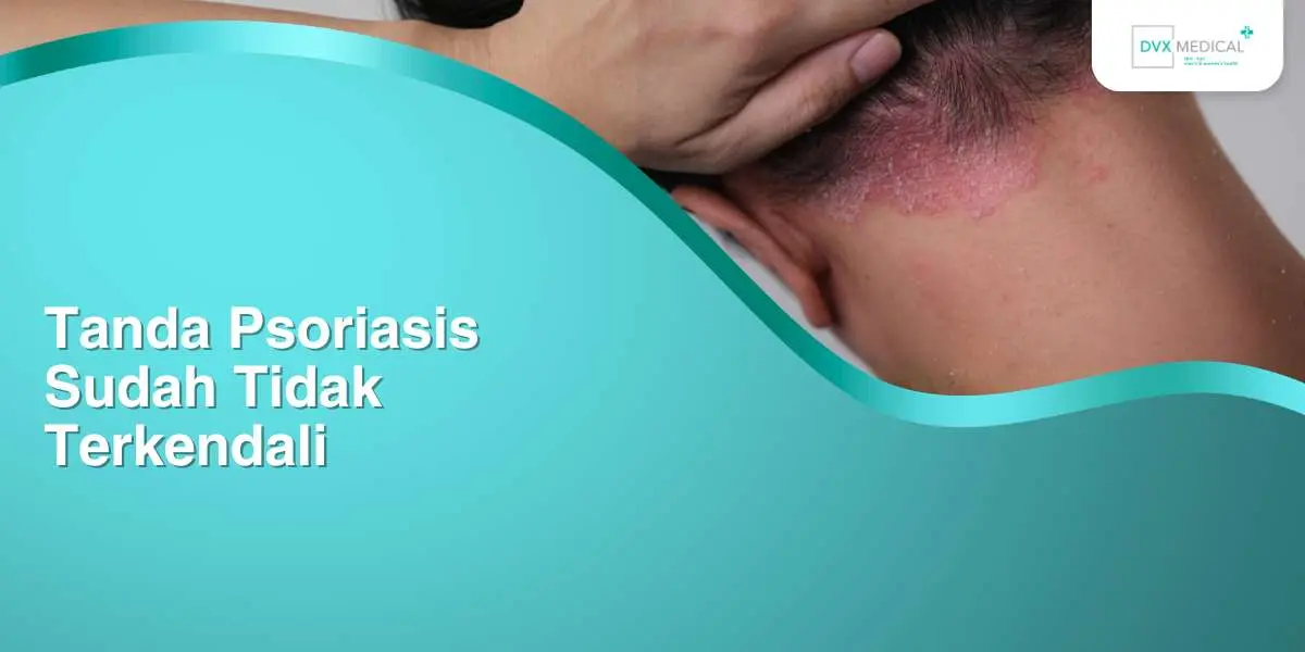 Tanda Psoriasis Sudah Tidak Terkendali