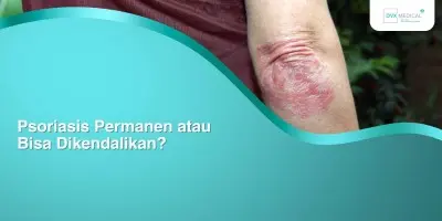 Psoriasis Permanen atau Bisa Dikendalikan?