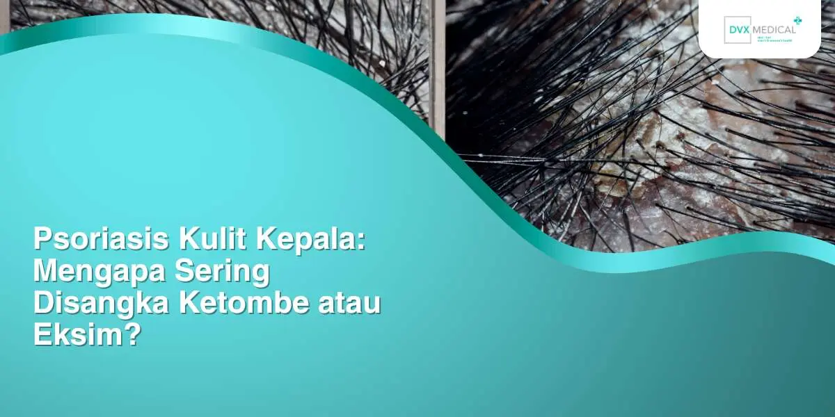 Psoriasis Kulit Kepala: Mengapa Sering Disangka Ketombe atau Eksim?