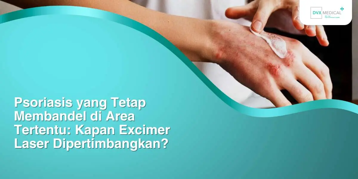 Psoriasis yang Tetap Membandel di Area Tertentu: Kapan Excimer Laser Dipertimbangkan?