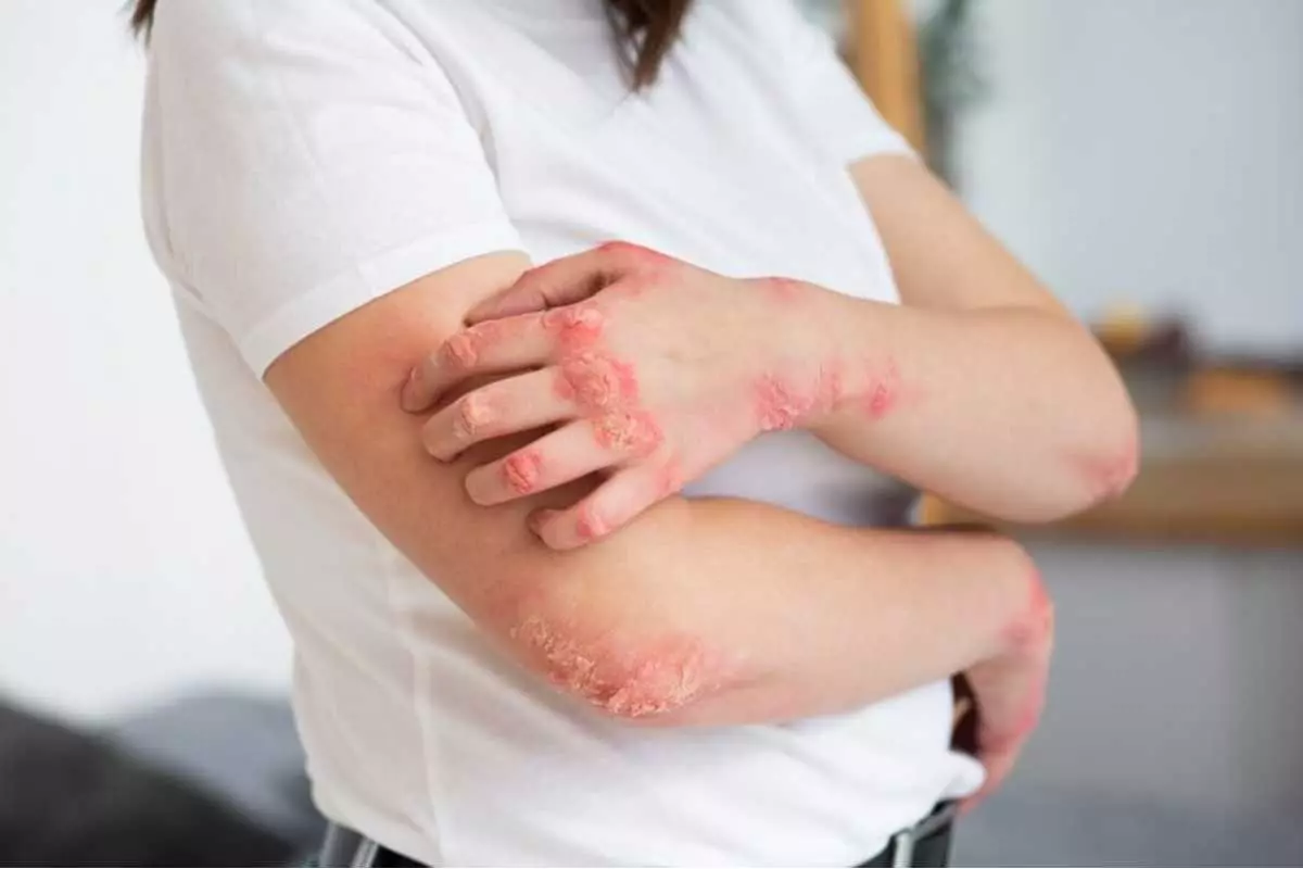 Penyebab Psoriasis