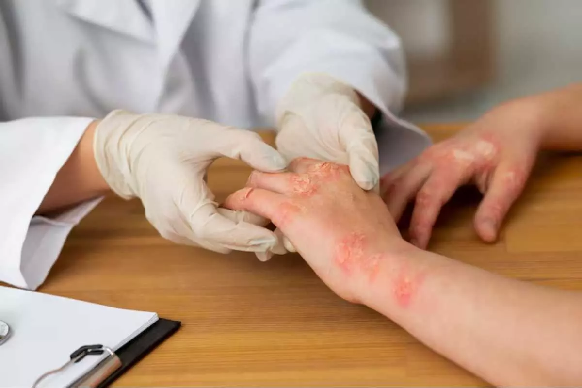 Mengenali Gejala Psoriasis: Jangan Abaikan Tanda-Tanda Ini