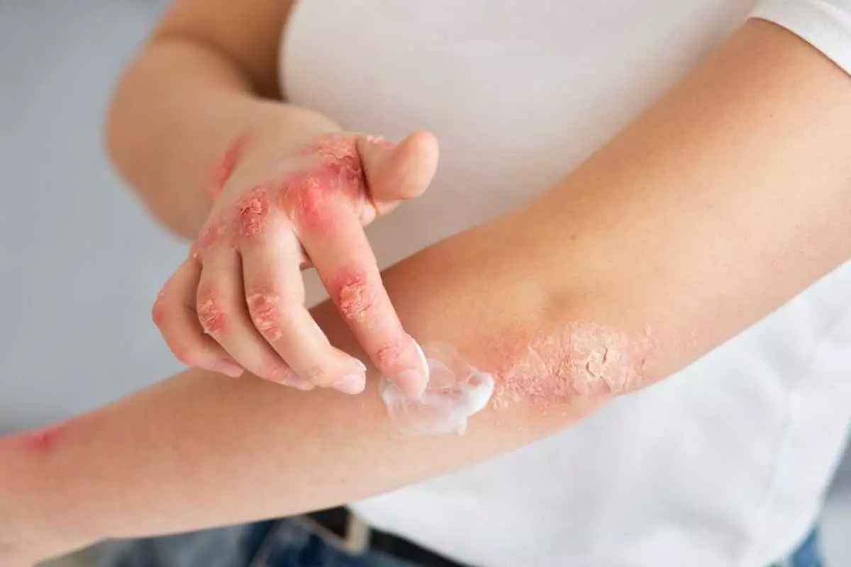 Tips Mengendalikan Psoriasis