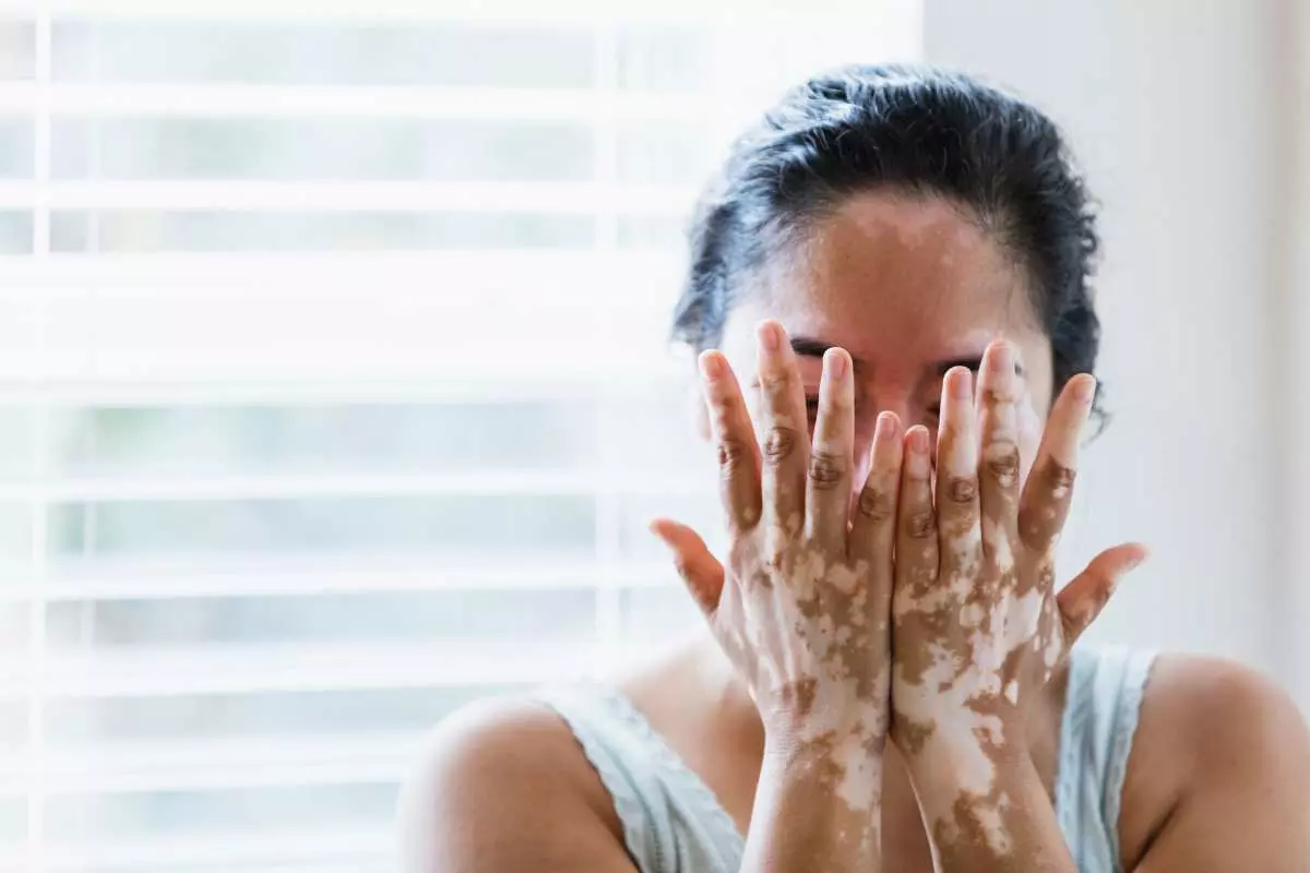 Penyebab Vitiligo