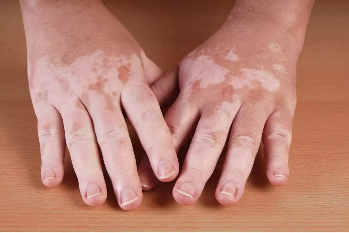 Dampak Vitiligo