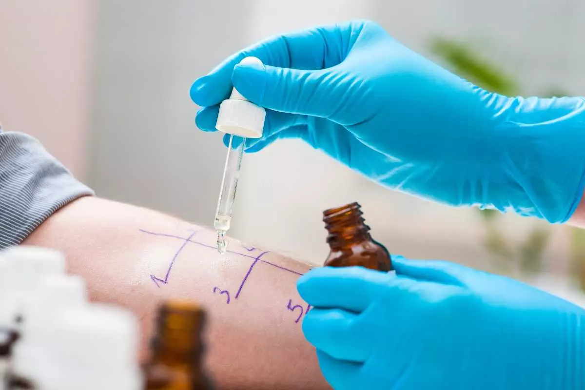 Apa Itu Skin Prick Test?