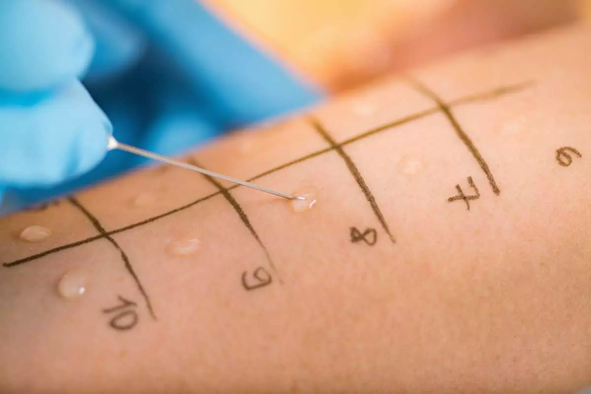 Persiapan Sebelum Skin Prick Test