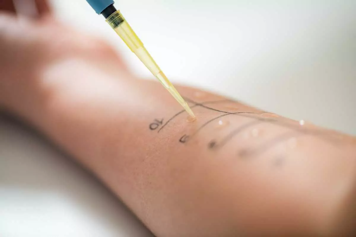 Prosedur Skin Prick Test