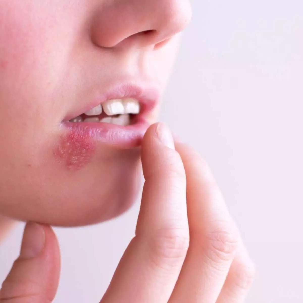 Dampak Herpes Simpleks Terhadap Kesehatan Kulit