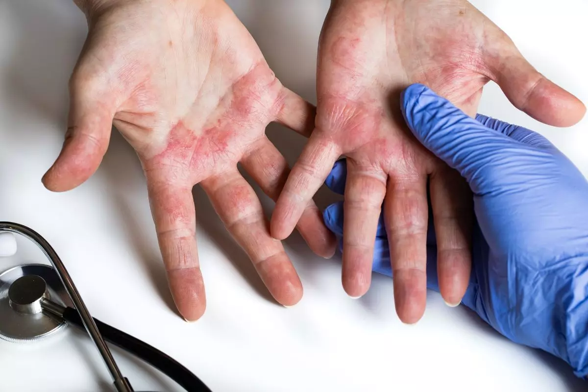 1. Dermatitis Kontak Iritan