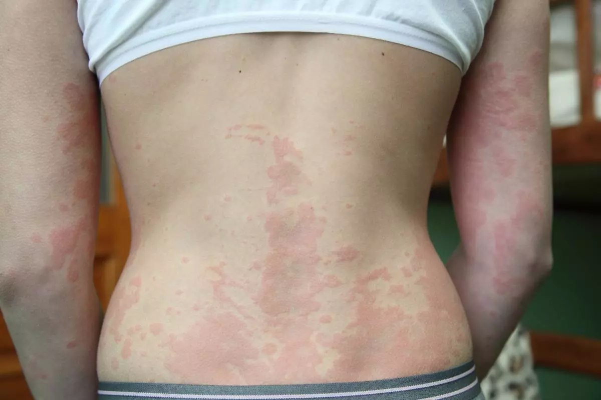 2. Dermatitis Kontak Alergi