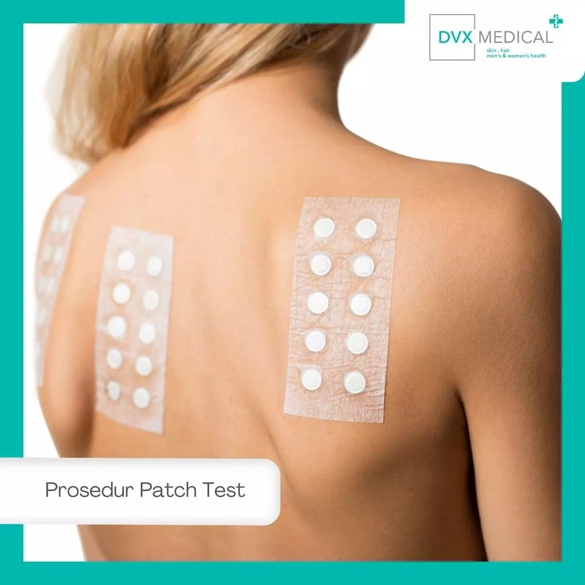 1. Prosedur Patch Test