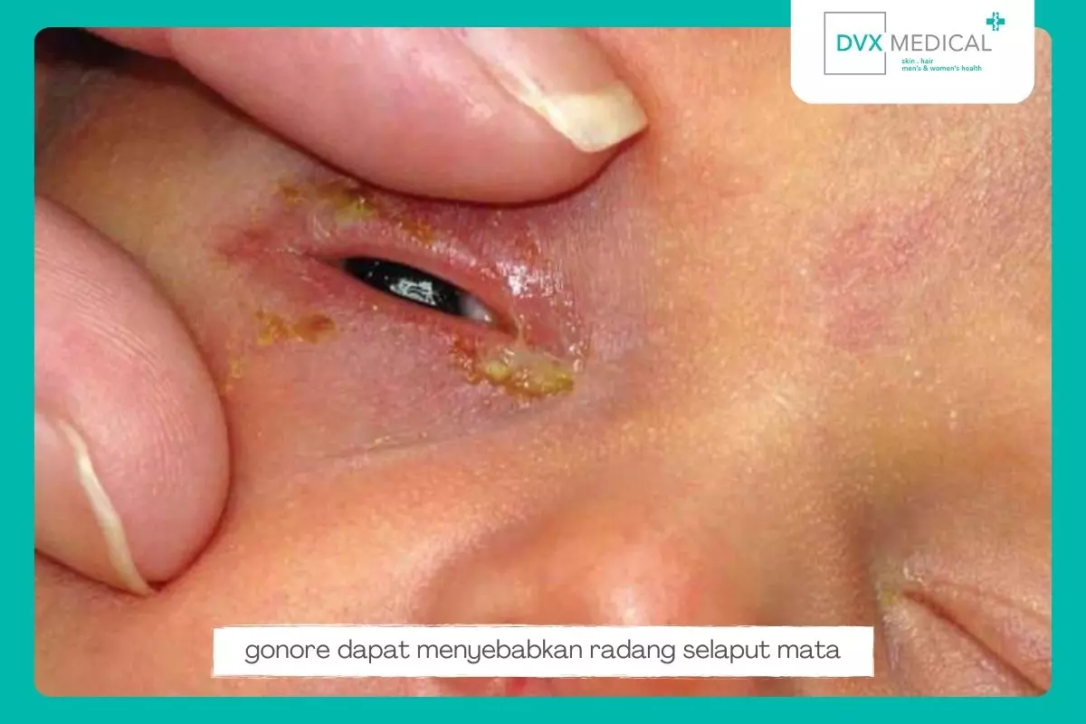 7. Infeksi pada Mata