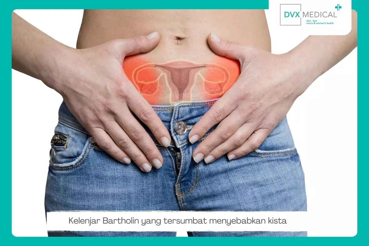 1. Kista Bartholin