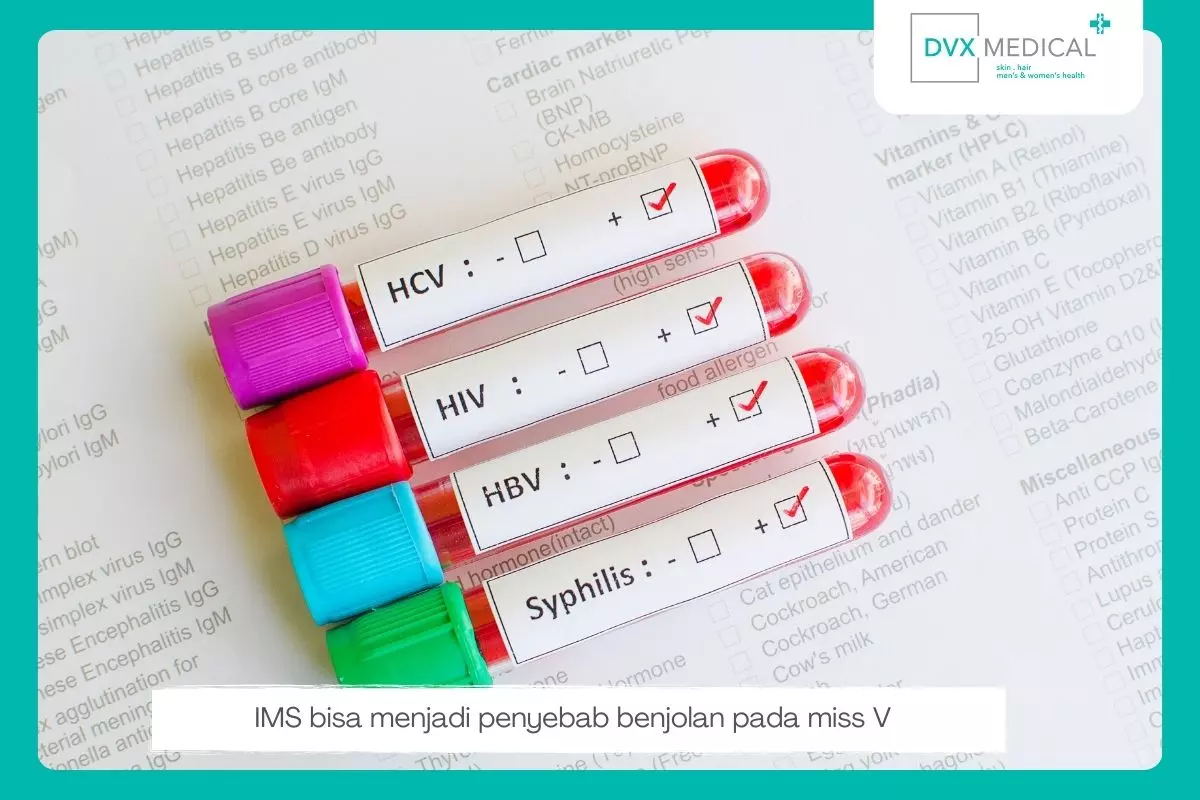 2. Infeksi Menular Seksual (IMS)