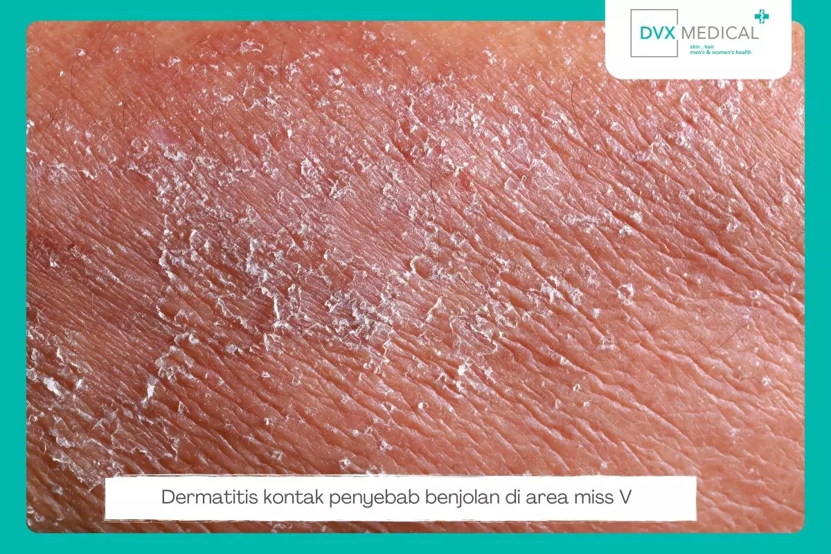 6. Dermatitis Kontak