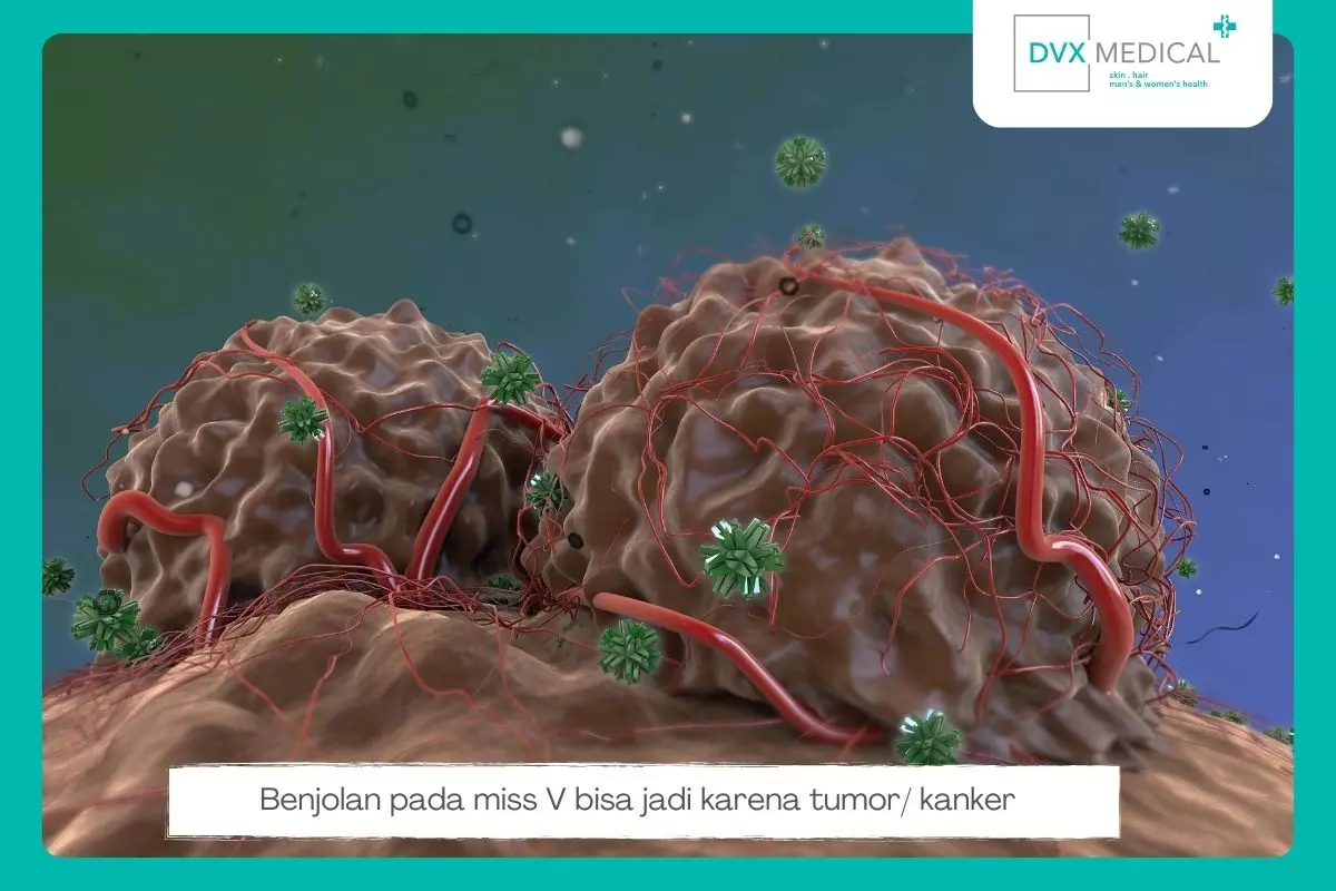 7. Tumor atau Kanker