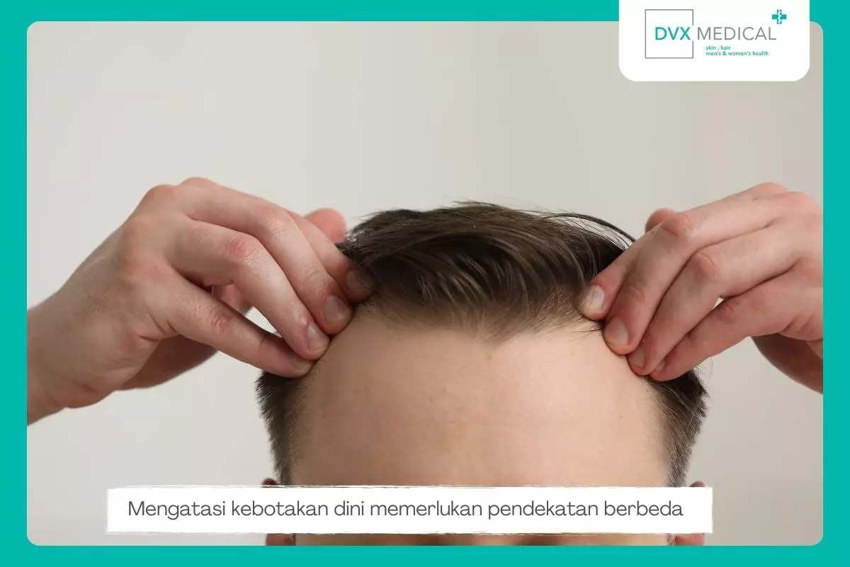 Cara Mengatasi Kebotakan Dini